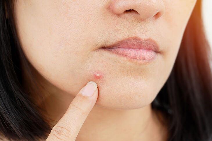 Mụn bọc là một dạng của mụn viêm ngứa thường xuyên xuất hiện trên da