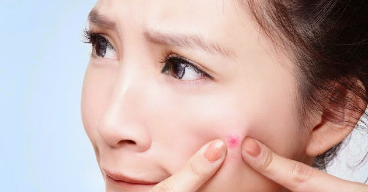 Nặn mụn giúp gia tăng tình trạng tổn thương da đặc biệt là các vết thâm khó điều trị