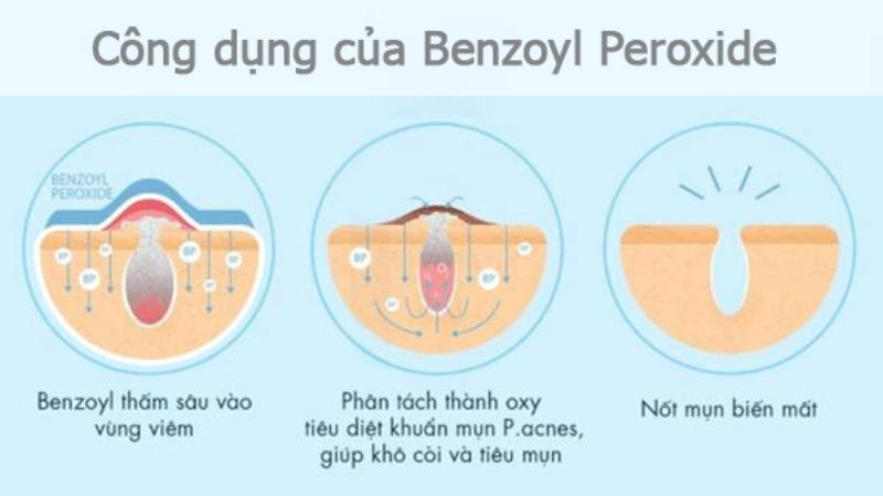 Cơ chế hoạt động của Benzoyl Peroxide