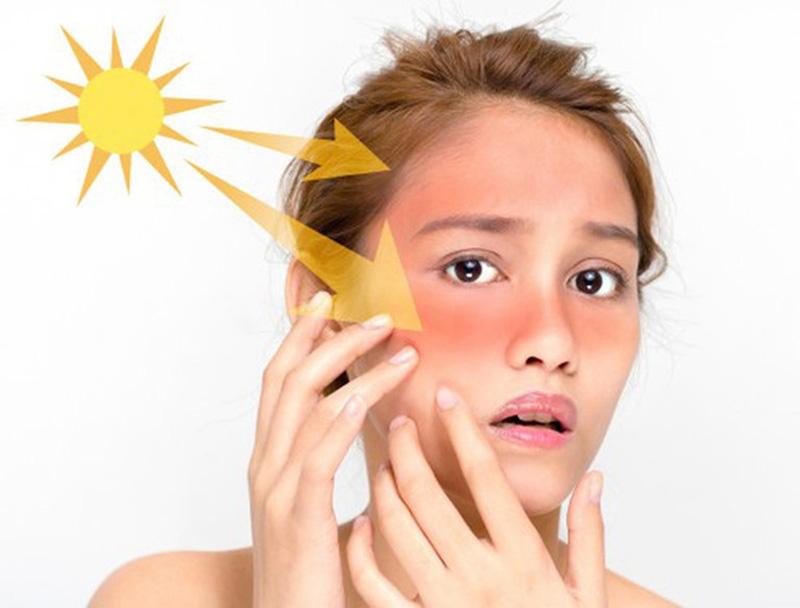Kem chống nắng phổ rộng là cần thiết cho da dầu mụn
