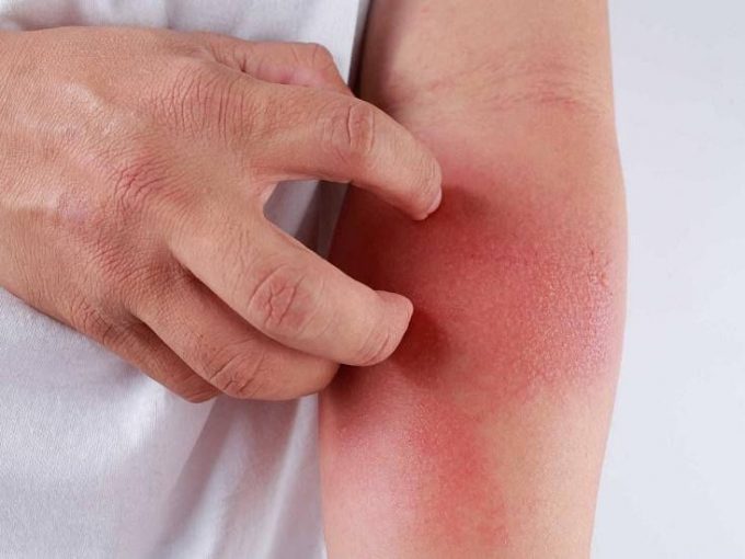 Viêm da tiếp xúc dị ứng: Nguyên nhân và cách điều trị hiệu quả