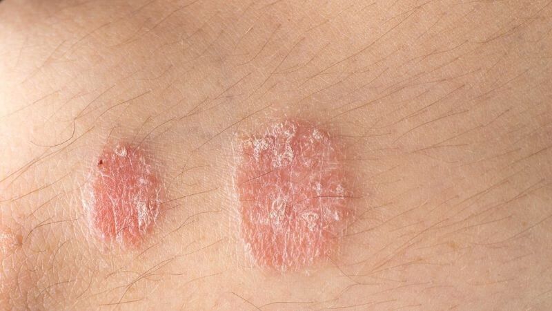 Bệnh vẩy nến thường là các mảng da dày, bị đỏ và phủ trắng