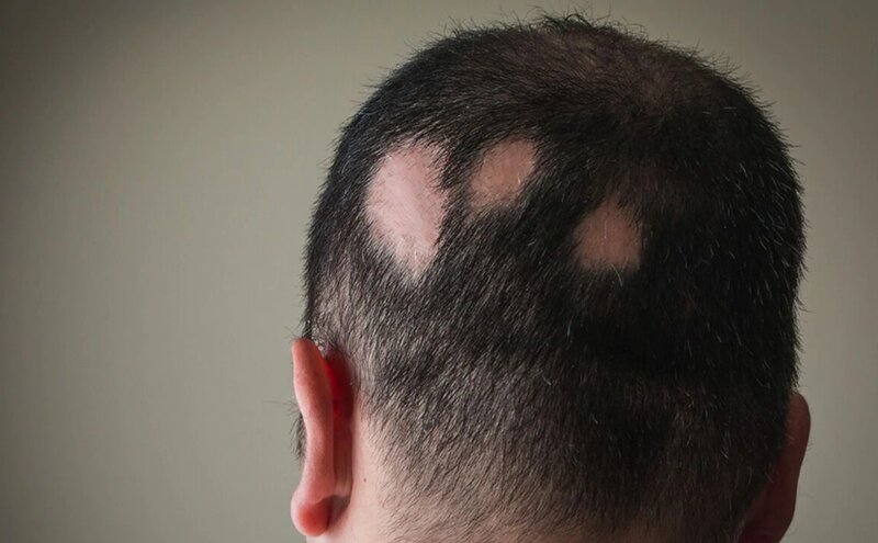 Tóc rụng thành từng mảng là triệu chứng tiêu biểu của bệnh Alopecia Areata
