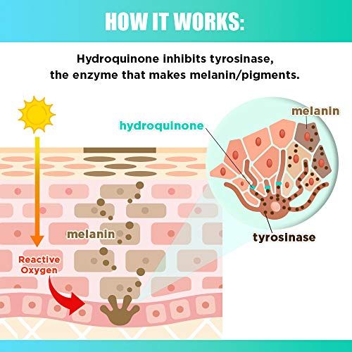 Hydroquinone giúp ngăn chặn hình thành melanin có thể xem là một cách trị nám nội tiết