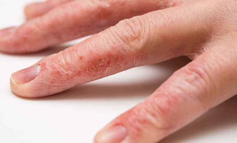 Dấu hiệu của bàn tay khi đang bị viêm da