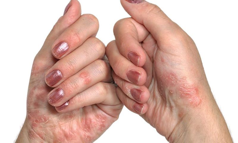 Bệnh viêm da do cơ địa ở tay gây ra nhiều khó chịu cho người mắc