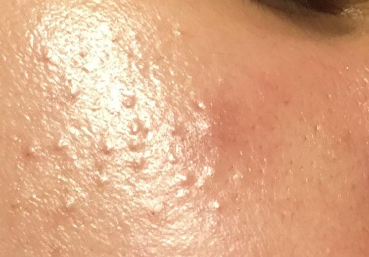 Các bước skincare cơ bản cho da dầu mụn như thế nào để da luôn đẹp?