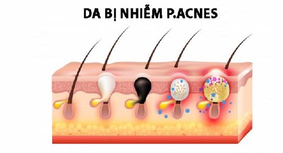 Da bị nhiễm khuẩn P.acnes