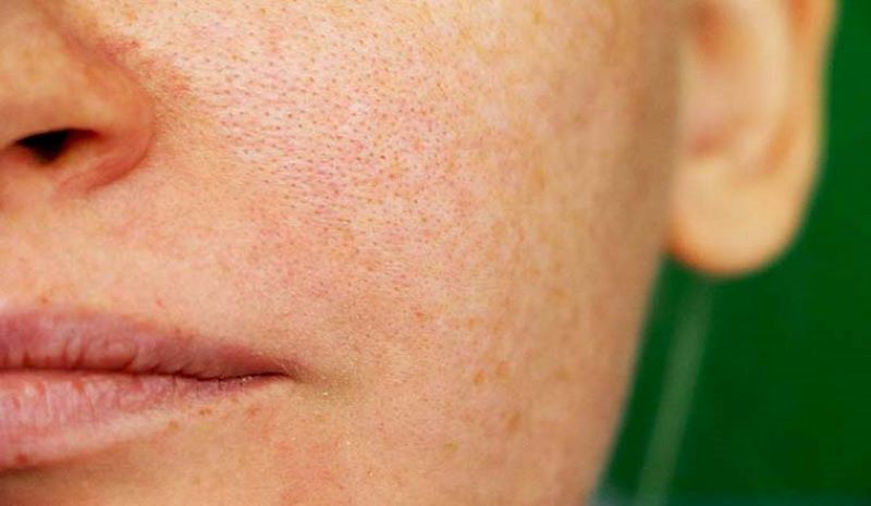 Viêm lỗ chân lông là vấn đề thường gặp ở những làn da dầu