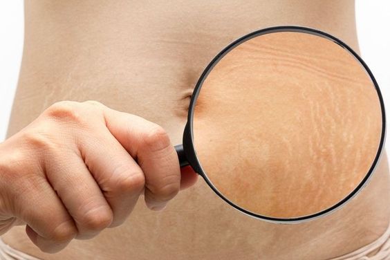 Gợi ý top kem trị rạn da lâu năm và nguyên nhân, dấu hiệu của rạn da