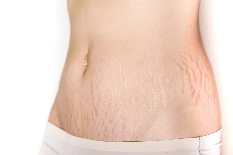 Rạn da là tình trạng phổ biến ở phụ nữ trong giai đoạn mang thai và sau sinh