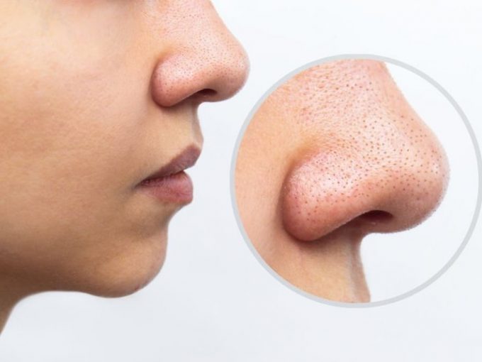Bật mí các sản phẩm trị sợi bã nhờn ở mũi giúp phá bỏ nỗi lo mụn sần
