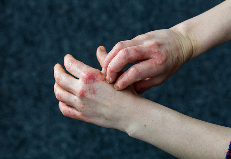 Viêm da cơ địa ở tay gây nhiều bất tiện cho sinh hoạt hàng ngày
