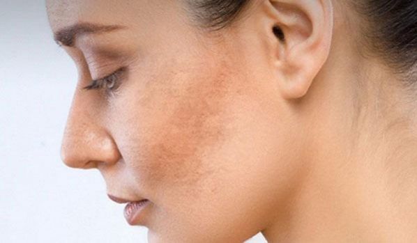 Tại sao da mặt khó trắng dù đã bảo vệ và chăm sóc da kỹ?