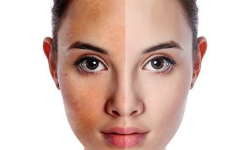 Tại sao da mặt khó trắng là một vấn đề phức tạp, được ảnh hưởng bởi nhiều yếu tố khác nhau